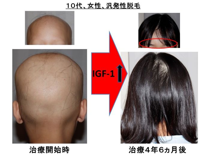 円形脱毛症　病院